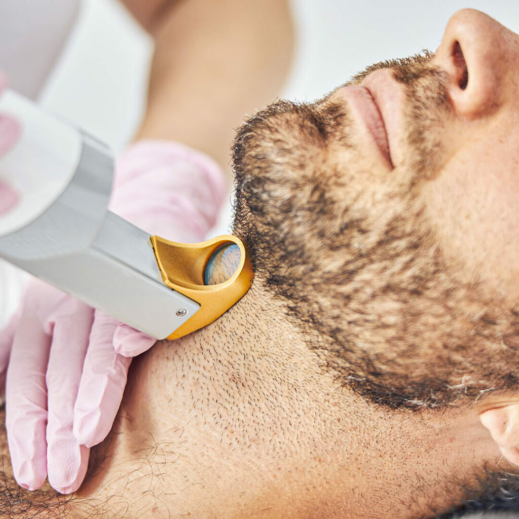 Faixa de Barba (laser)